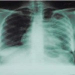 Situação do RN em relação à tuberculose, é relativamente confortável.
